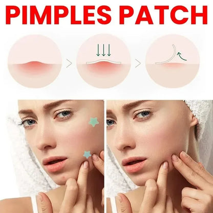 200pcs Repair Acne Patch Facial Skin Care